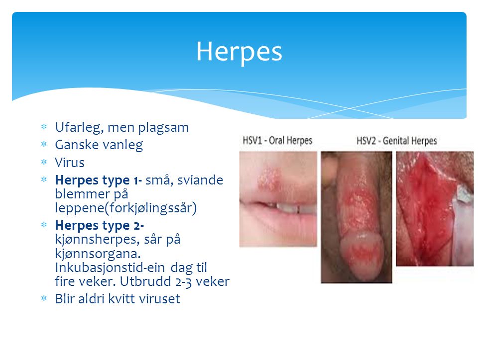 Herpes  Ufarleg, men plagsam  Ganske vanleg  Virus  Herpes type 1- små, sviande blemmer på leppene(forkjølingssår)  Herpes type 2- kjønnsherpes, sår på kjønnsorgana.