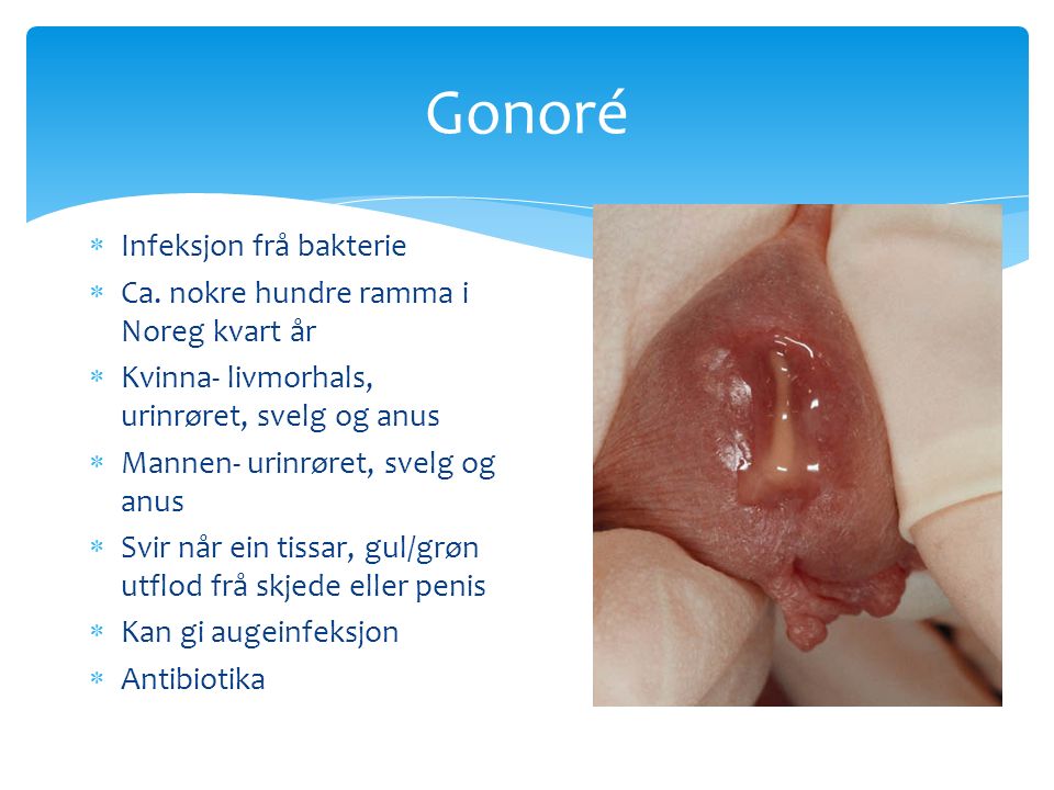 Gonoré  Infeksjon frå bakterie  Ca.