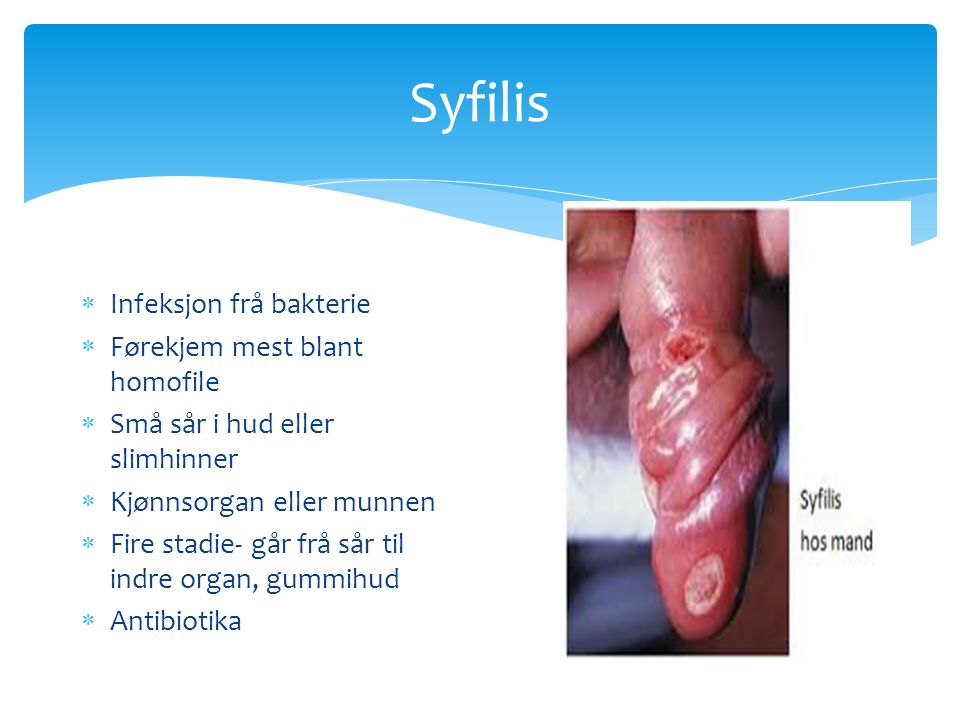 Syfilis  Infeksjon frå bakterie  Førekjem mest blant homofile  Små sår i hud eller slimhinner  Kjønnsorgan eller munnen  Fire stadie- går frå sår til indre organ, gummihud  Antibiotika