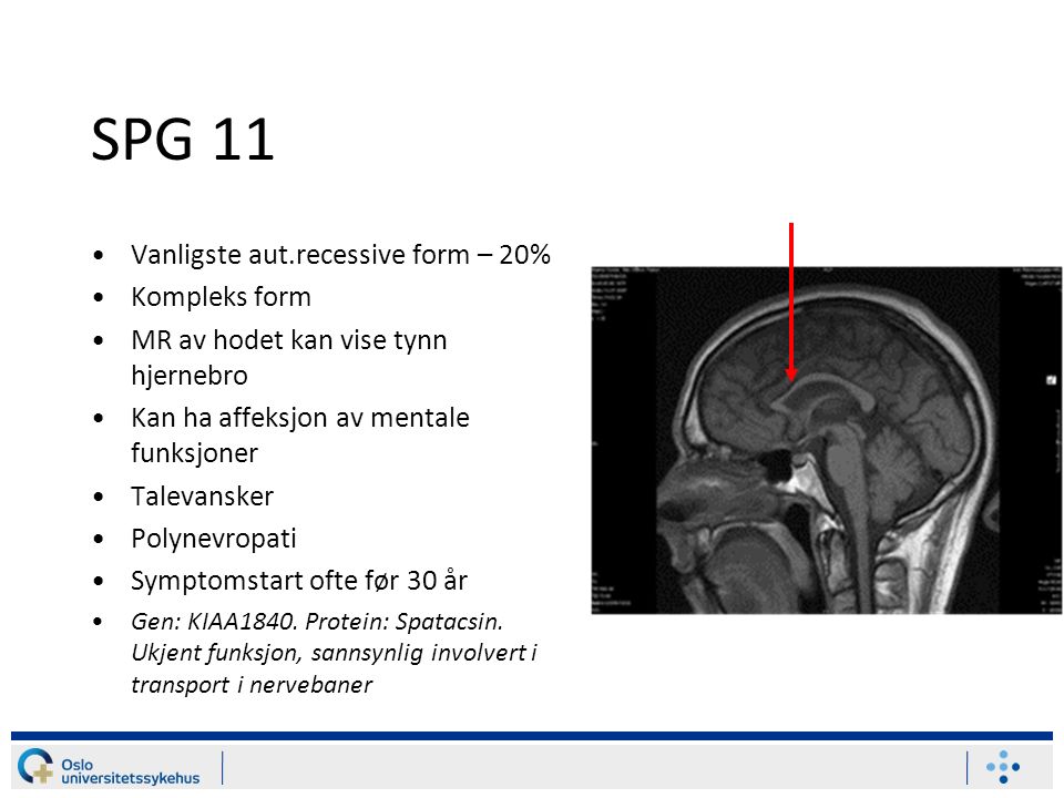 SPG 11 Vanligste aut.recessive form – 20% Kompleks form MR av hodet kan vise tynn hjernebro Kan ha affeksjon av mentale funksjoner Talevansker Polynevropati Symptomstart ofte før 30 år Gen: KIAA1840.