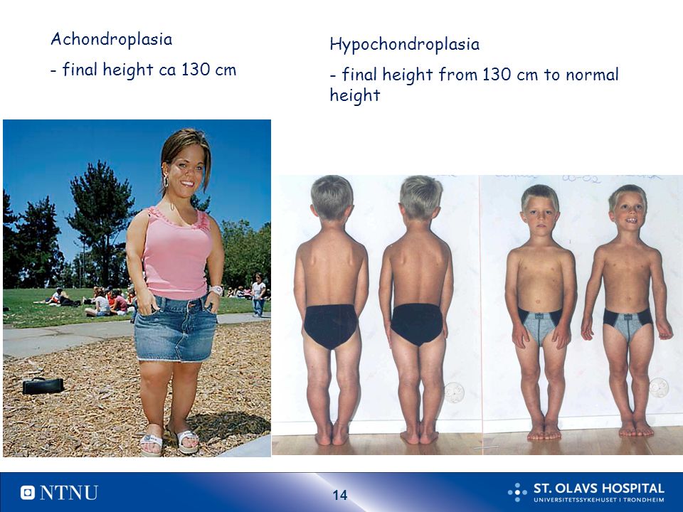14 Achondroplasia - final height ca 130 cm Hypochondroplasia - final height from 130 cm to normal height